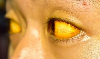 Dinkes Jatim Bantah Ada Kasus Hepatitis Akut Misterius di Jatim: 114 Pasien Itu Kuning Akut