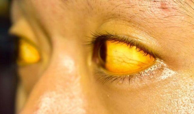 Dinkes Jatim Bantah Ada Kasus Hepatitis Akut Misterius di Jatim: 114 Pasien Itu Kuning Akut